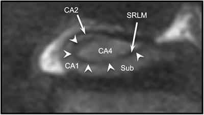 Clear and Consistent Imaging of Hippocampal Internal Architecture With High Resolution Multiple Image Co-registration and Averaging (HR-MICRA)